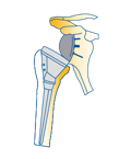 Arthroplastie par prothèse totale de l’épaule avec inversion de l’emplacement de la tête et de la cupule.