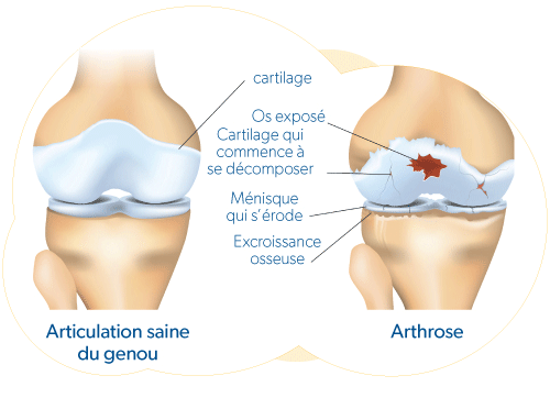 Healty knee joint and damaged asteoarthritis knee