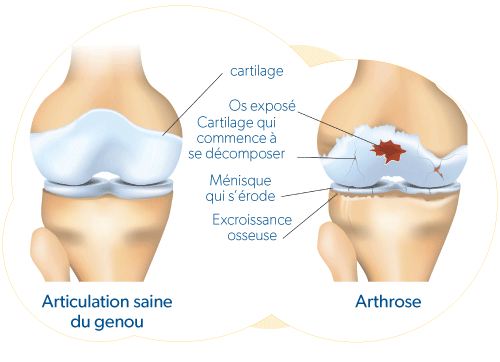 À propos de l'arthrose du genou