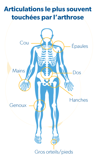 Squelette qui montre les joints atteinds d'arthrose