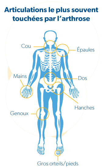 Symptômes, signes et diagnostic de l'arthrose