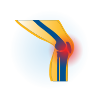 Icon of osteoarthritis knee pain