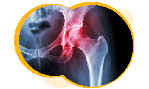 Diagnosing osteoarthritis with a x-ray