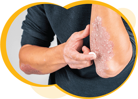 Une personne à la peau moyennement claire appliquant une crème topique sur une plaque de psoriasis de l’avant-bras.