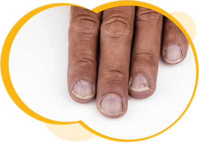 Gros plan de quatre doigts d’une personne à la peau moyennement foncée avec des ongles montrant des érosions ponctuées cupuliformes et des crêtes sur la surface.