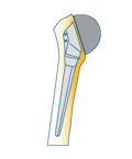 Prothèse partielle de l’épaule sphéroïde.