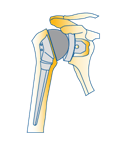 Prothèse totale anatomique de l’épaule sphéroïde avec cupule.