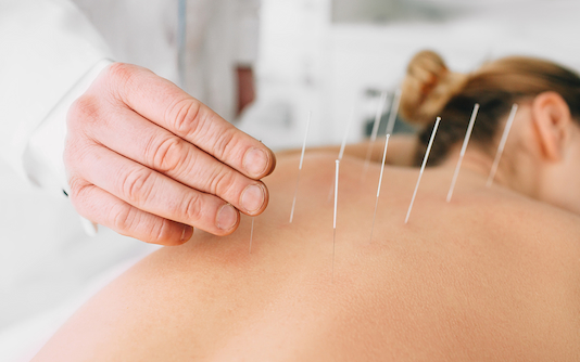 A woman lying down with acupuncture needles in her back