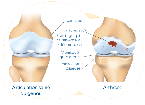Arthrose